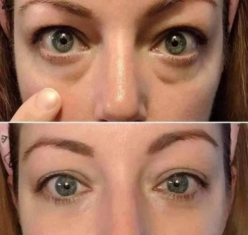 Avant après Accent sur la zone du contour des yeux